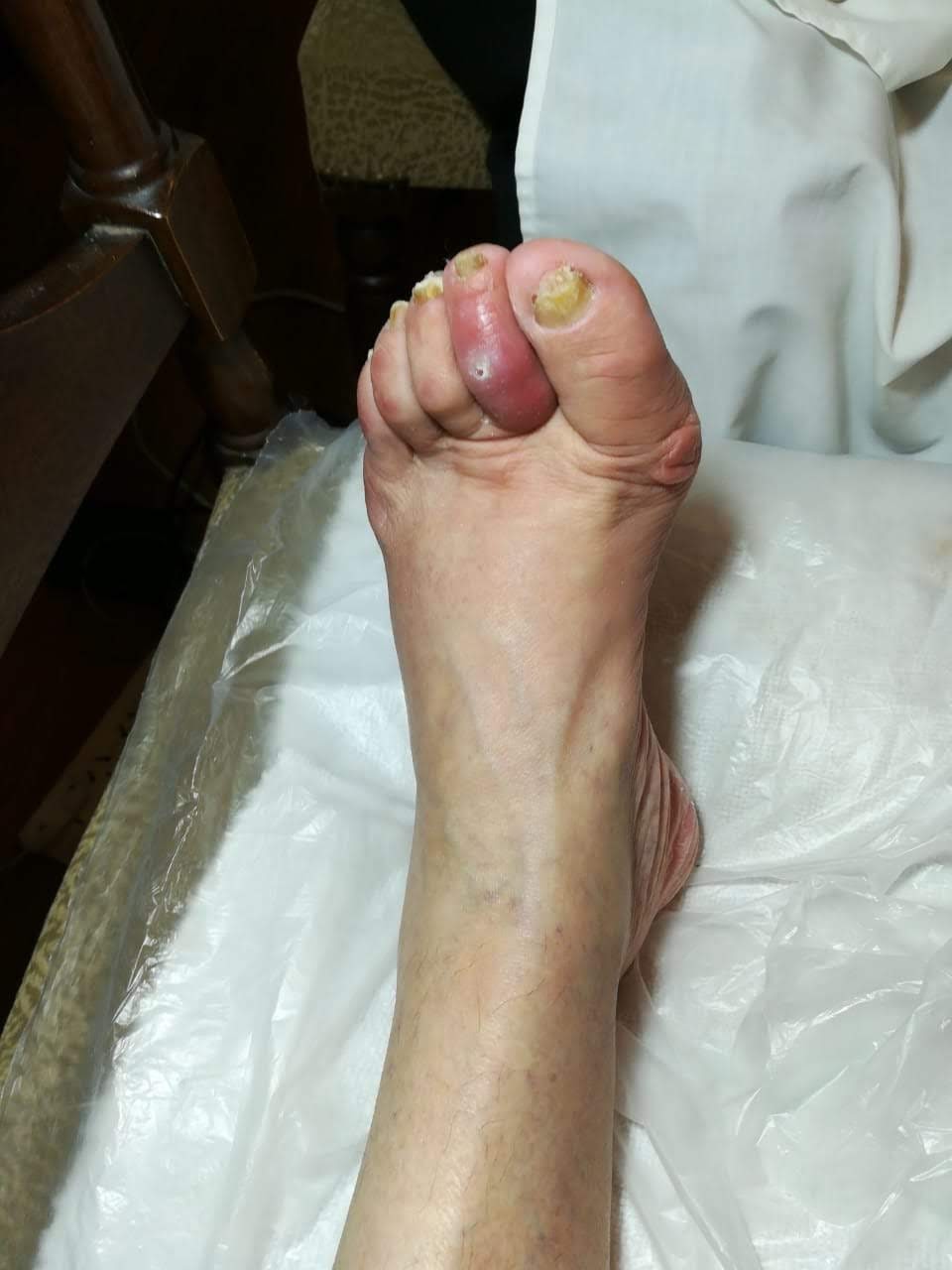Infección en dedo