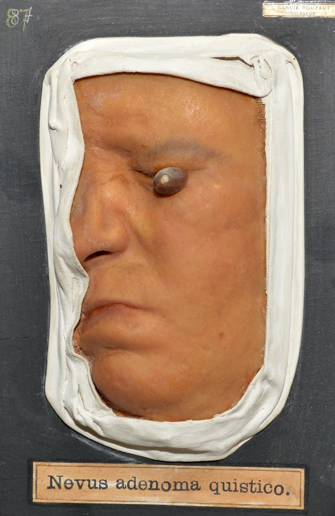 nevus_adenoma_quistico