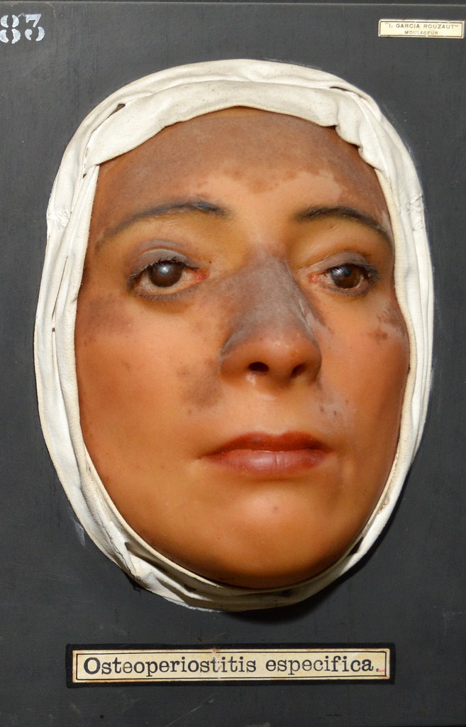 osteoperiostitis_especifica