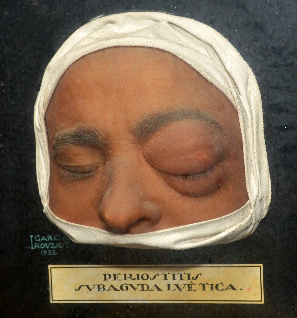 periostitis_luetica