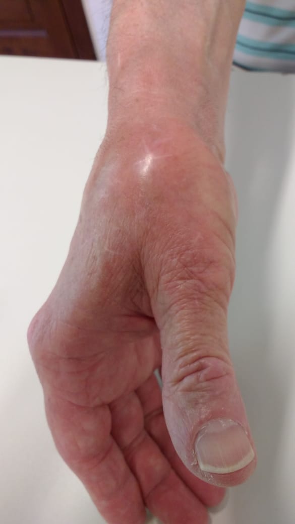 tendinitis