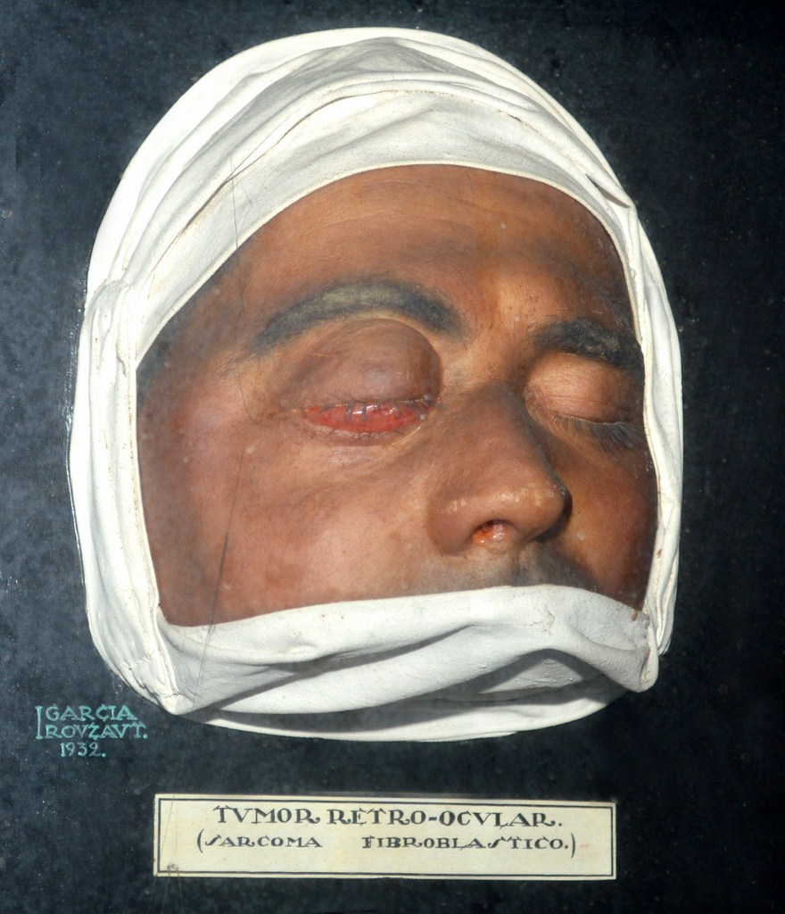 tumor_retroocular