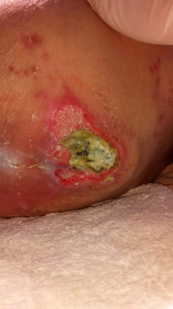 ulcerapordecubito