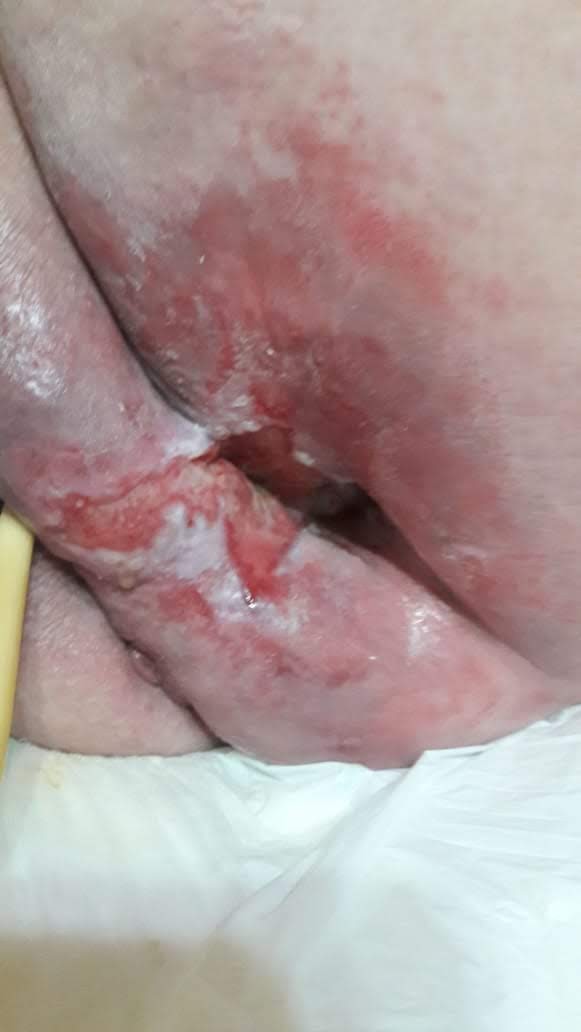 ulcerapordecubito4