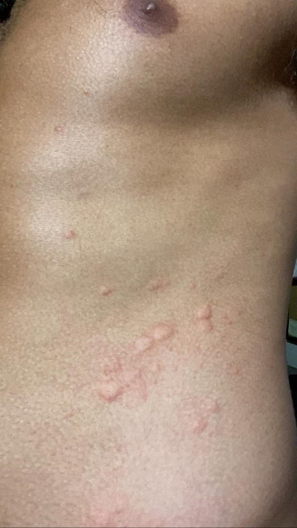 urticaria