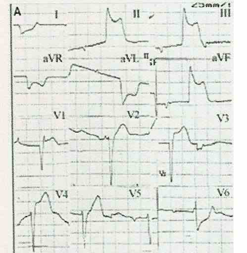 infarto4