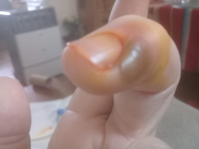 Absceso en dedo
