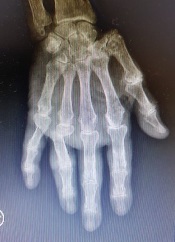 Fractura de 1er falange anular y meñique