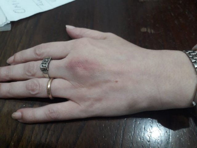 Tendinitis