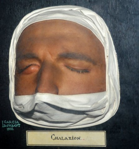 chalazion