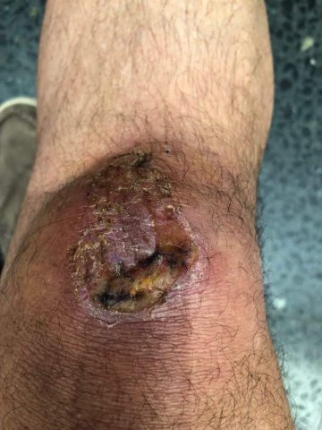 Cicatrización de herida en rodilla