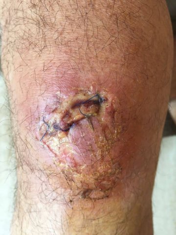 Cicatrización de herida en rodilla