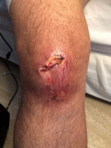 Cicatrización de herida en rodilla