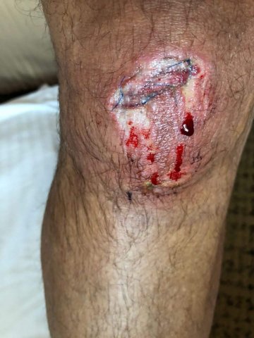 Herida traumática en rodilla