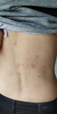 Herpes Zoster