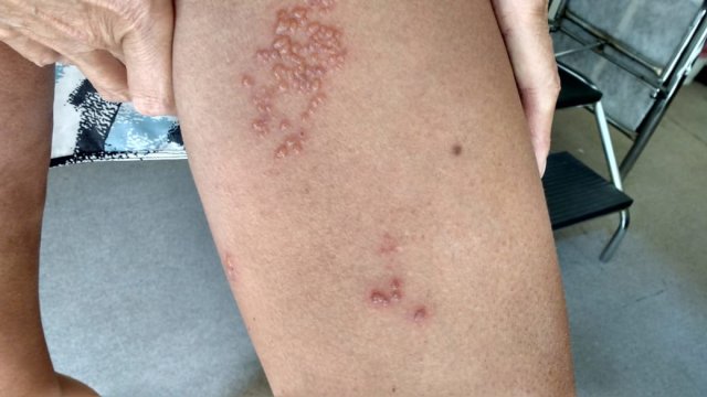 Herpes Zoster