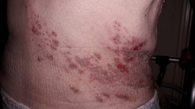 Herpes Zoster (evolución)