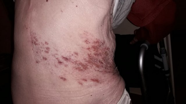 Herpes Zoster (evolución)