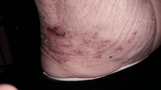 Herpes Zoster (evolución)