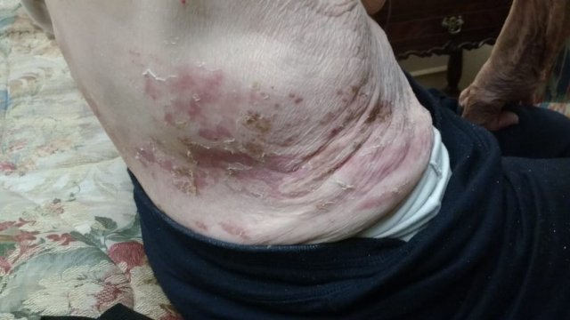 Herpes Zoster (evolución)