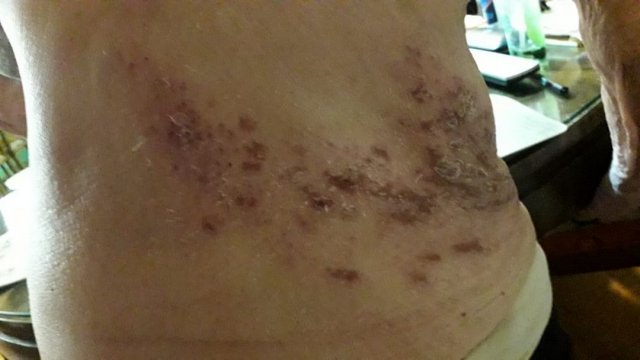 Herpes Zoster (evolución)