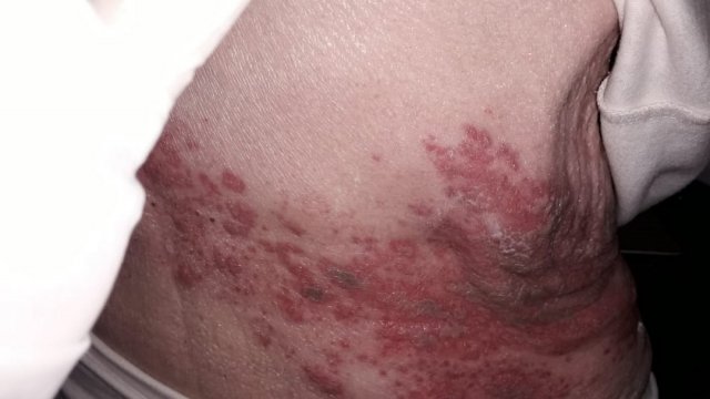 Herpes Zoster (evolución)