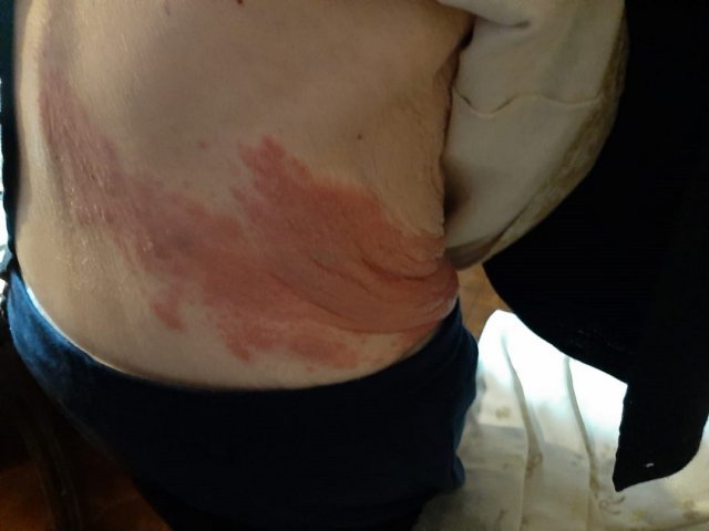 Herpes Zoster (evolución)