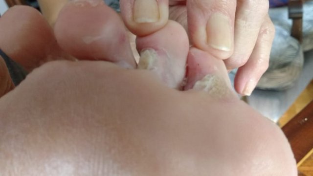 Micosis