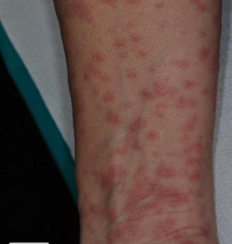 Reacción dérmica por coronavirus