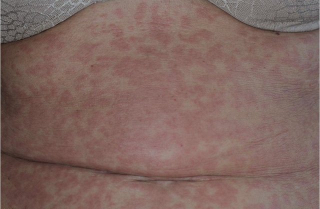 Reacción dérmica por coronavirus