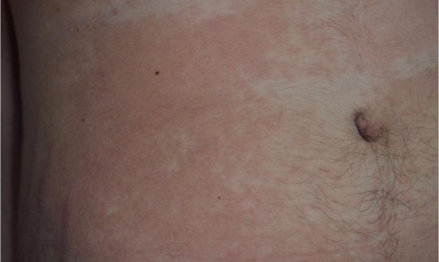 Reacción dérmica por coronavirus