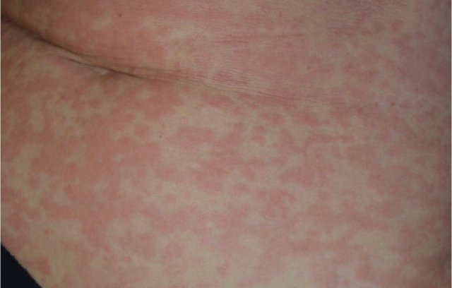 Reacción dérmica por coronavirus