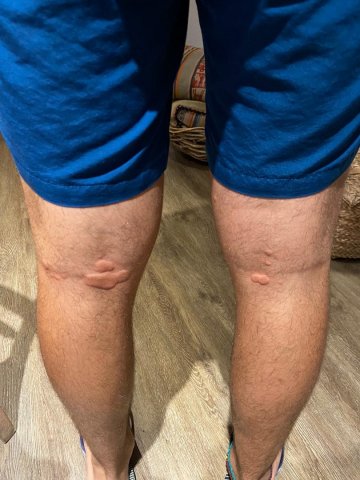 Urticaria gigante
