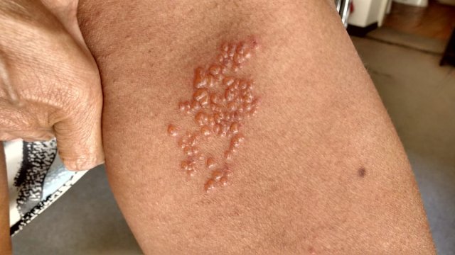 Vesículas por herpes zoster