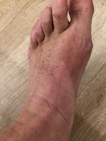 Bursitis metatarsiana