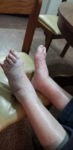 Edema unilateral