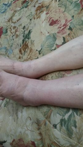 Edema unilateral de MI