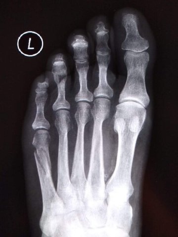 Fractura del 5to metatarsiano