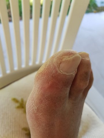 Artritis gotosa