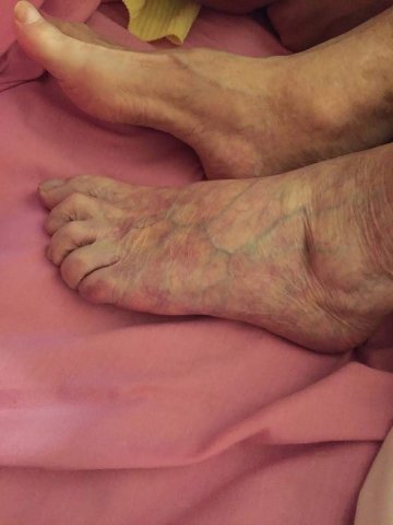 Trombosis arterial