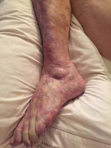 Trombosis arterial